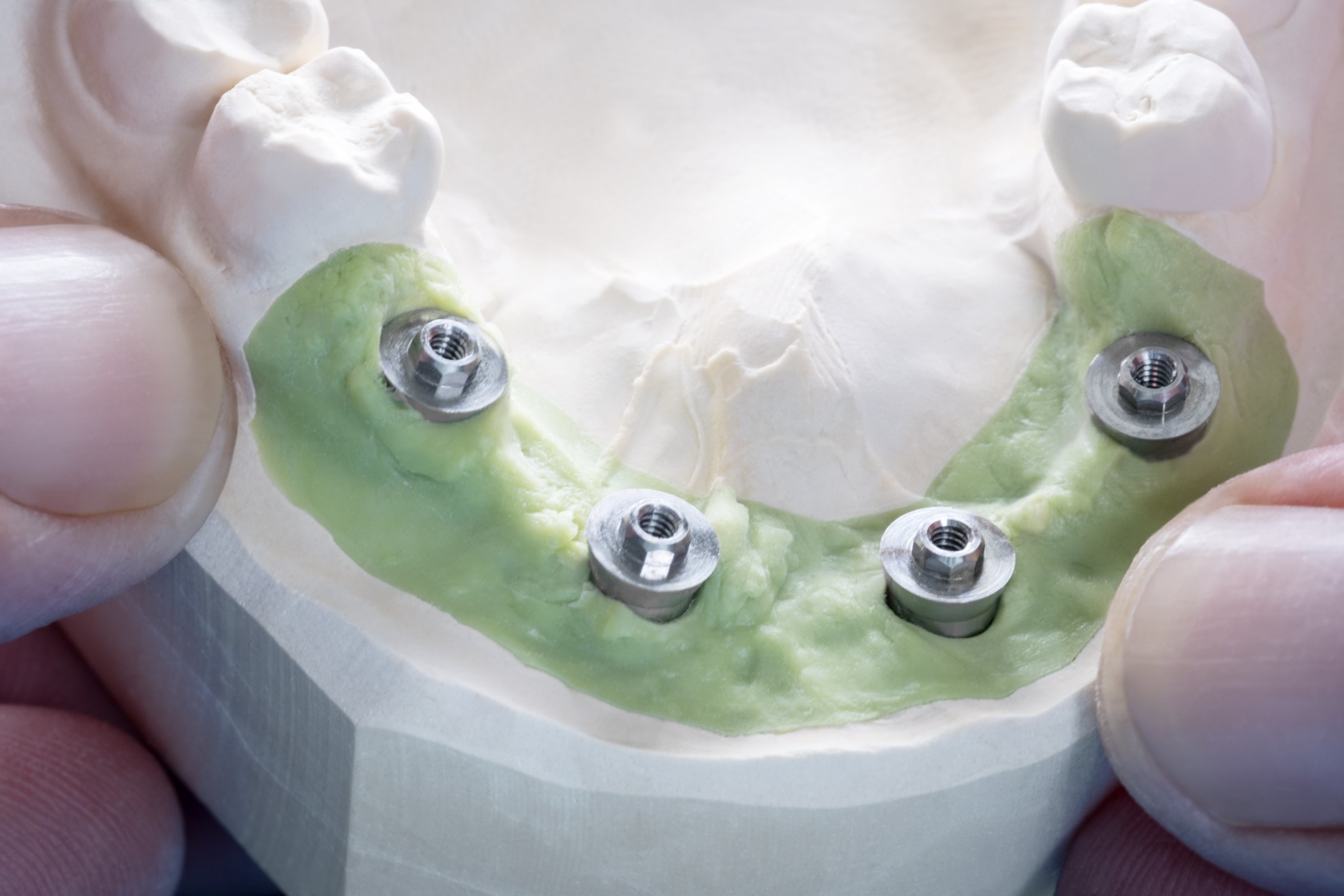 Ashford Dental Centre blog4.2-1 The Art & Science of Dental Implants Uncategorized  Oral Hygiene General Wellness Dental Health   