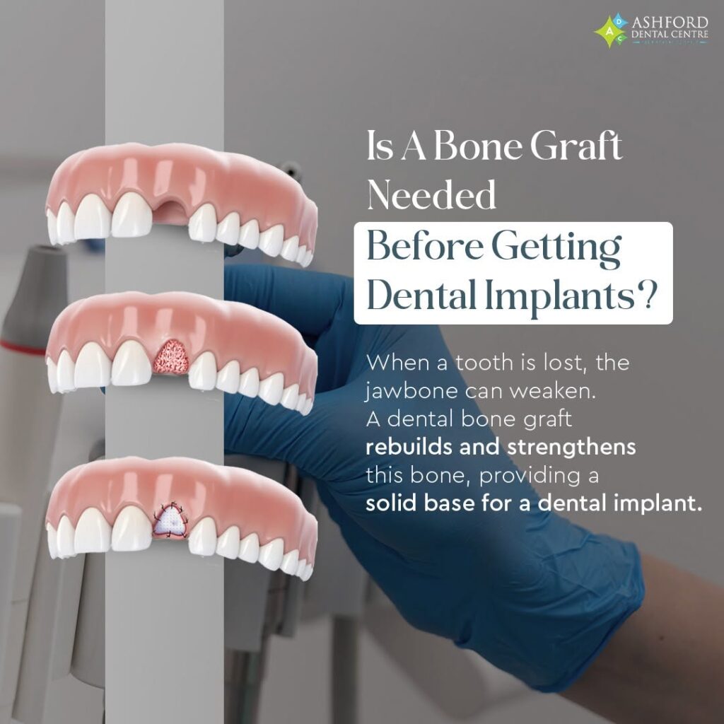 bone grafting before dental implant